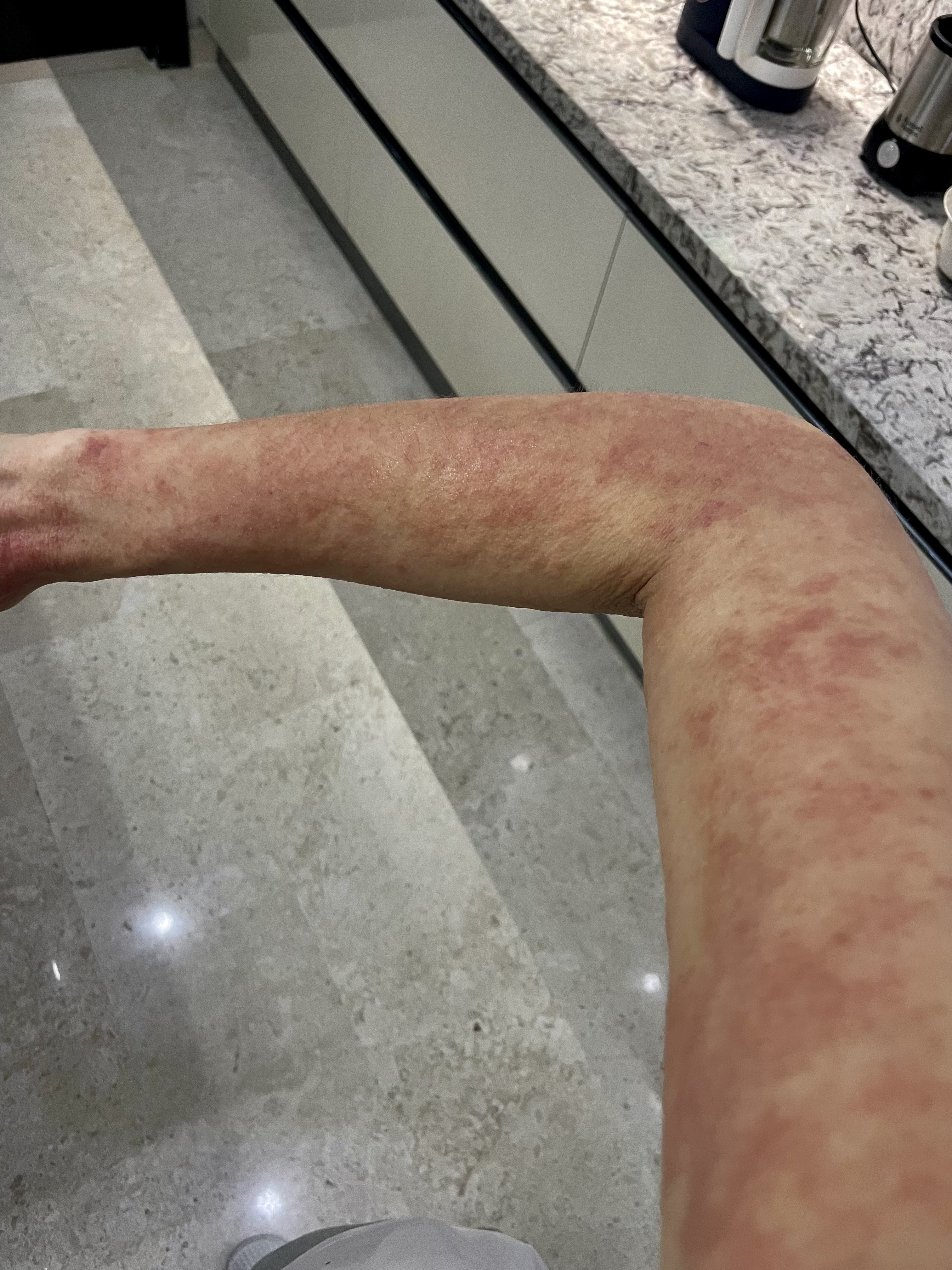 Arm during TSW